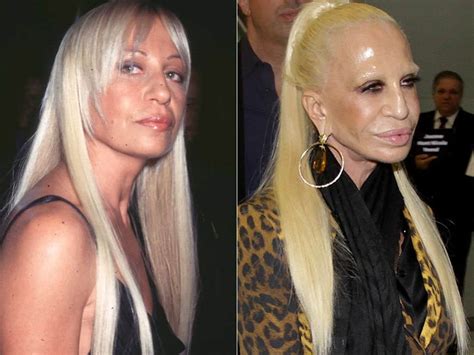 versace bad plastic surgery|Botched: 12 Celebrities Who Had the Craziest Plastic Surgery.